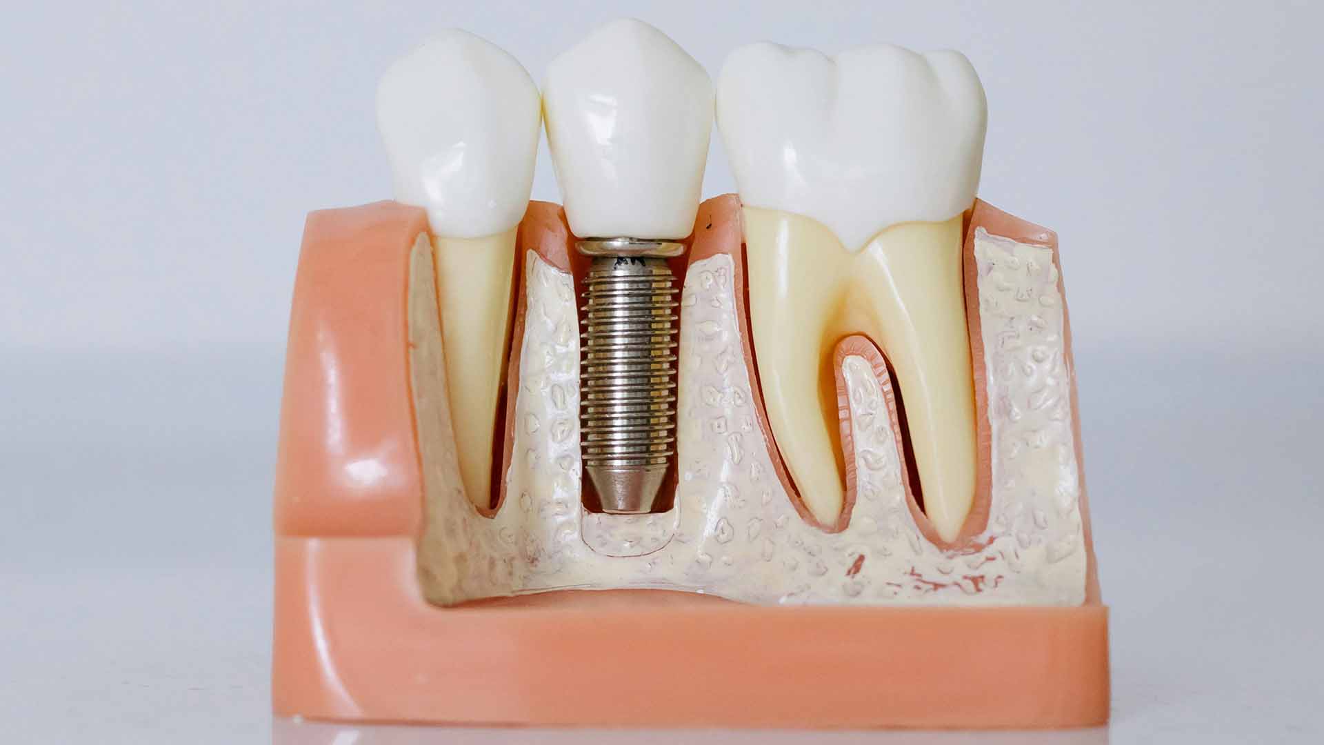 From Consultation to Restoration: How Long Does the Dental Implant Process Really Take?