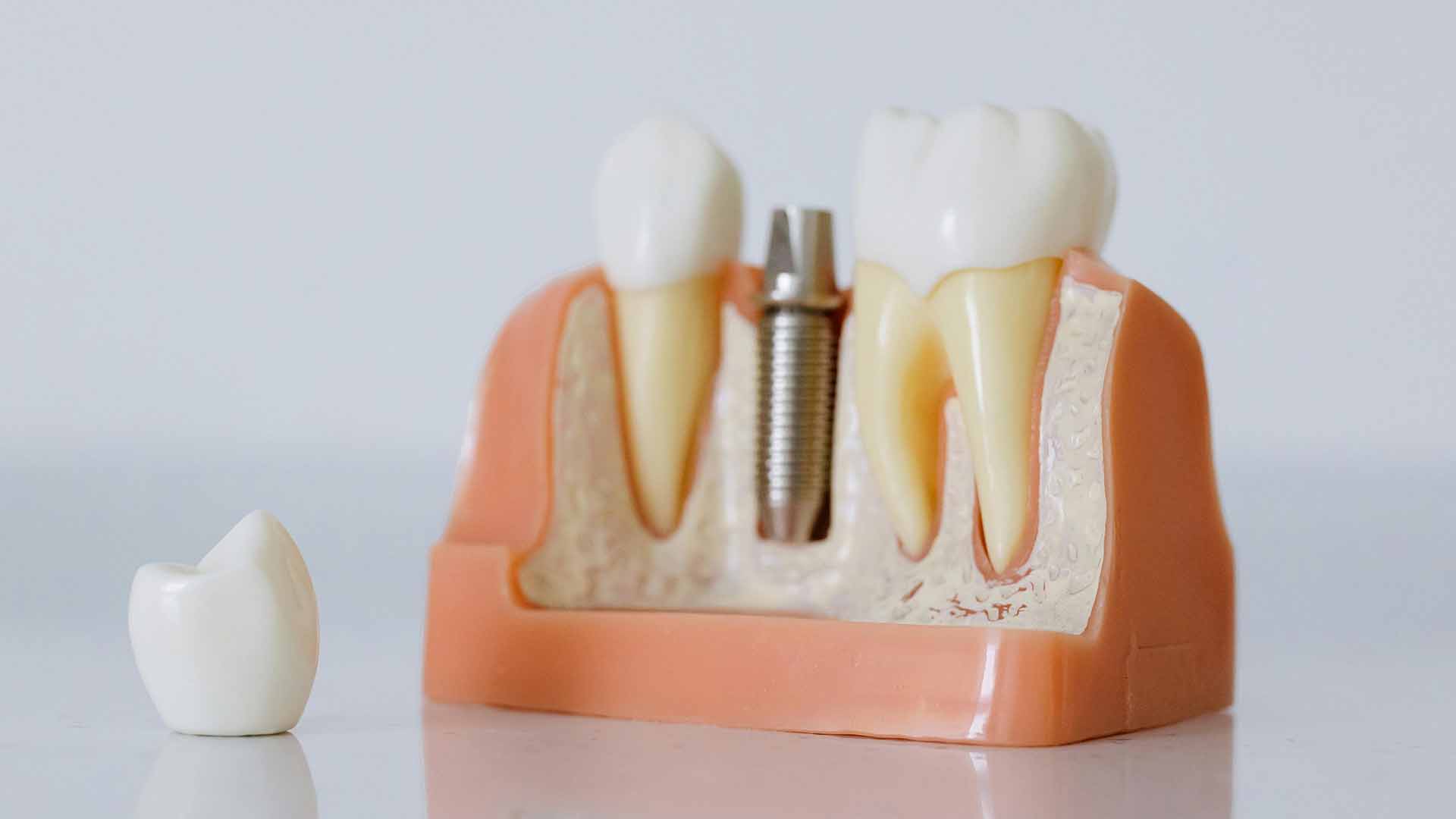 Exploring Dental Implant Grants and Financial Aid Options for Affordable Care: How to Get Help with Dental Implants