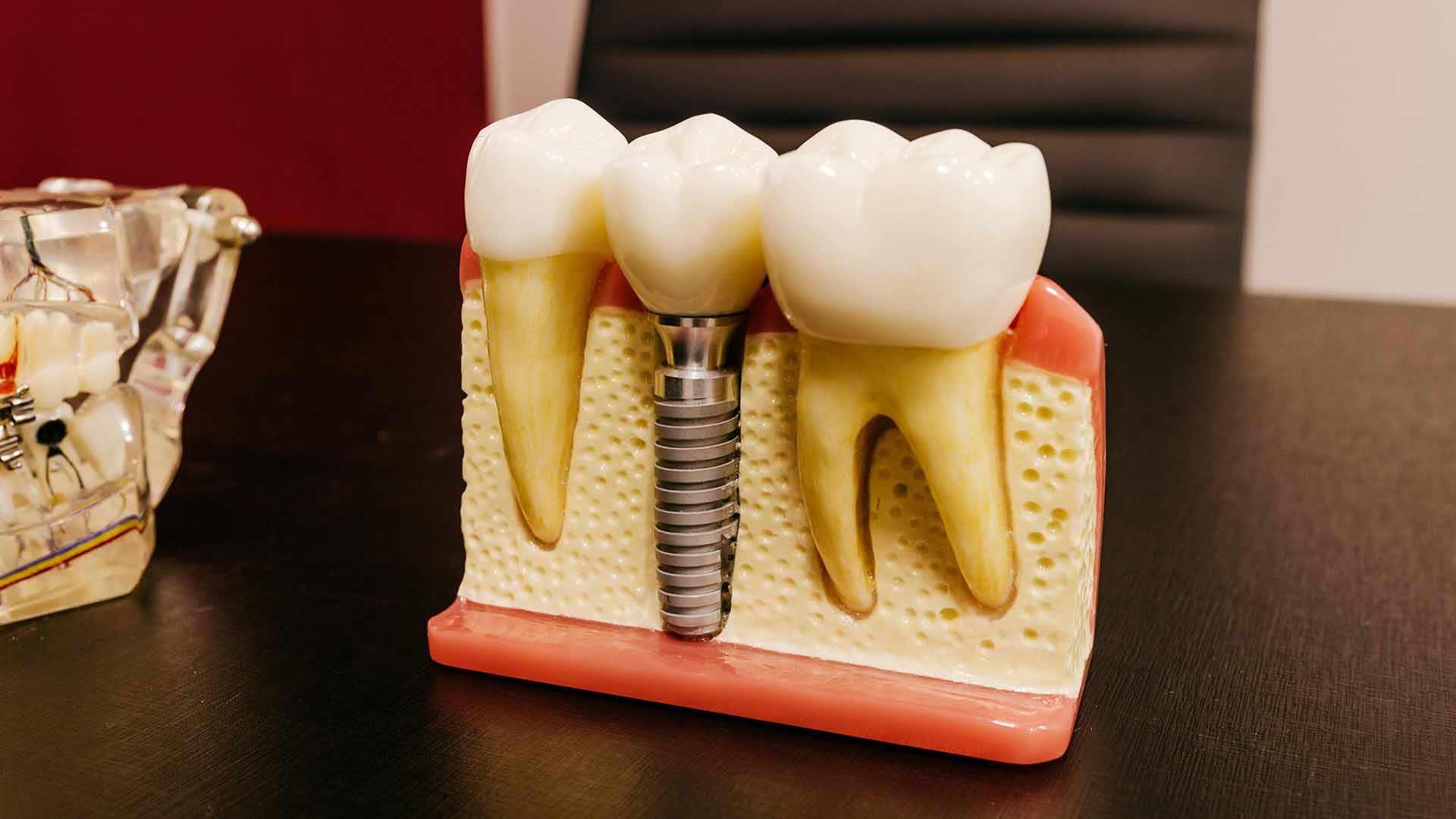 Understanding the Cost of Full Mouth Dental Implants: Price Range, Factors, and What to Expect