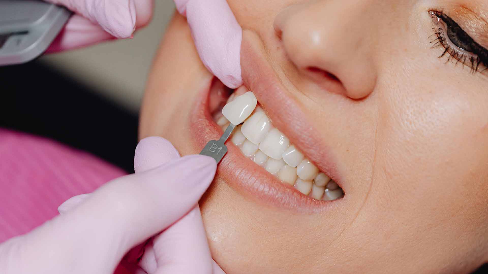 how much is teeth whitening at dentist with insurance