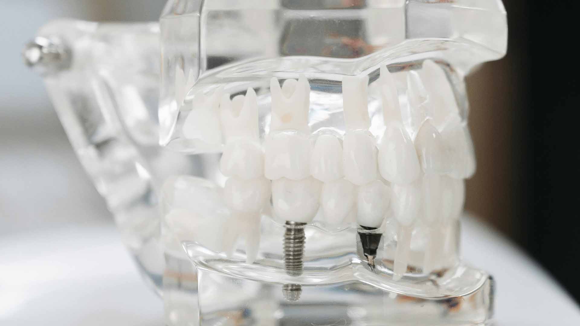 Does Medicaid Cover Dental Implants? Understanding Your Options